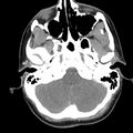 Normal CT of the neck (Radiopaedia 14575-14500 Axial C+ 13).jpg