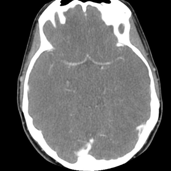 File:Normal CT of the neck (Radiopaedia 14575-14500 Axial C+ 2).jpg