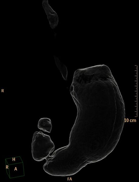 File:Normal CT virtual gastroscopy (Radiopaedia 29960-30501 3D Transparency view 5).jpg