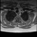 Normal cervical and thoracic spine MRI (Radiopaedia 35630-37156 Axial T1 C+ 2).png