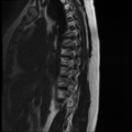Normal cervical and thoracic spine MRI (Radiopaedia 35630-37156 G 11).png