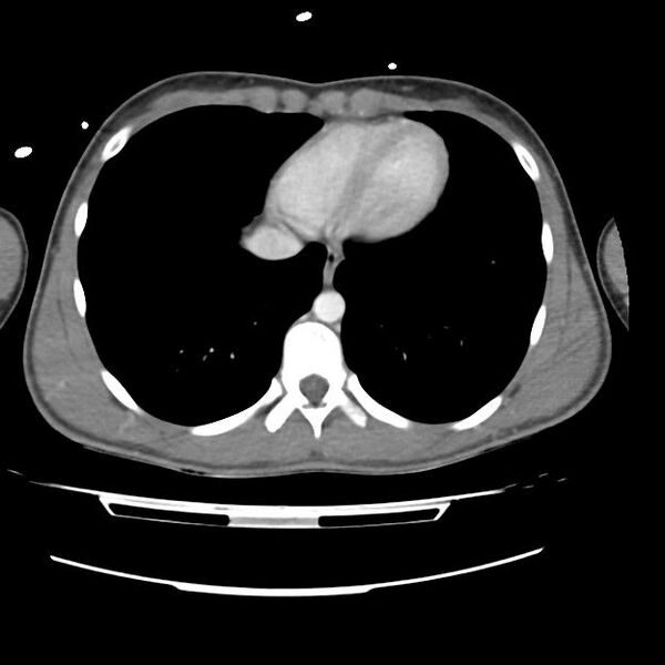File:Normal dual-phase trauma CT chest,abdomen and pelvis (Radiopaedia 48092-52899 A 41).jpg