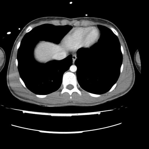 File:Normal dual-phase trauma CT chest,abdomen and pelvis (Radiopaedia 48092-52899 A 43).jpg