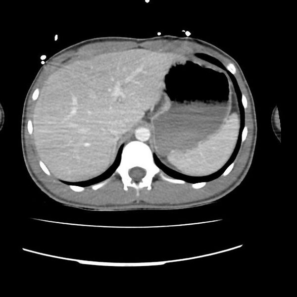 File:Normal dual-phase trauma CT chest,abdomen and pelvis (Radiopaedia 48092-52899 A 52).jpg