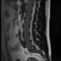 Normal lumbar spine MRI (Radiopaedia 35543-37039 Sagittal T2 5).png