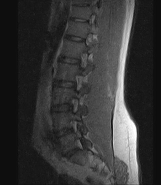 File:Normal lumbar spine MRI - low-field MRI scanner (Radiopaedia 40976-43699 Sagittal T1 9).jpg