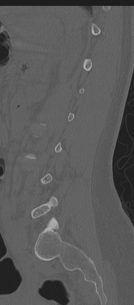 File:Normal lumbosacral CT (Radiopaedia 37923-39867 Sagittal bone window 32).png