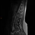 Normal spine MRI (Radiopaedia 77323-89408 Sagittal T1 10).jpg