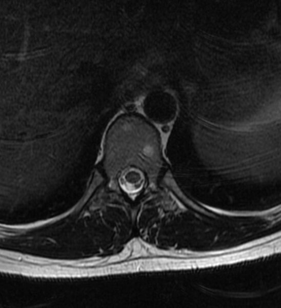 File:Normal thoracic spine MRI (Radiopaedia 41033-43781 Axial T2 15).jpg