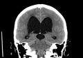 Obstructive hydrocephalus (Radiopaedia 30453-31119 Coronal non-contrast 24).jpg
