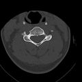 Occipital condyle fracture (Radiopaedia 31755-32691 Axial bone window 40).jpg