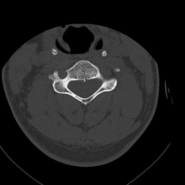 File:Occipital condyle fracture (Radiopaedia 31755-32691 Axial bone window 40).jpg