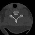 Occipital condyle fracture (Radiopaedia 31755-32691 Axial bone window 61).jpg