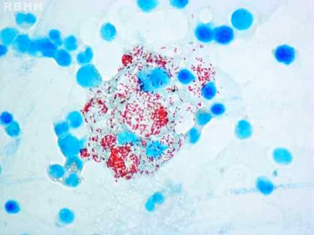 Histiocytes with their abundant cytoplasm filled with acid-fast bacilli (Mycobacterium leprae) in bone marrow