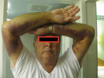 Acquired hemophilia A-extensive ecchymosis