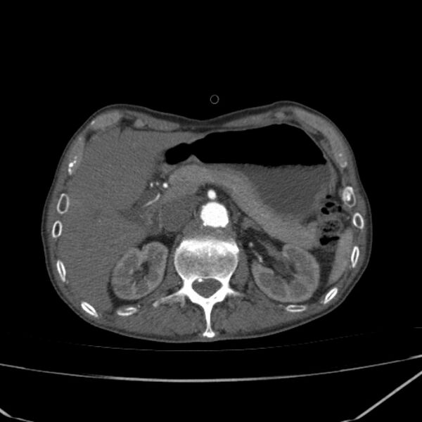 File:Abdominal aortic aneurysm (Radiopaedia 23703-23856 Axial C+ arterial phase 19).jpg