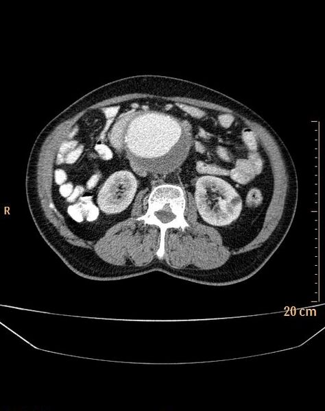 File:Abdominal aortic aneurysm (Radiopaedia 25985-26121 Axial C+ arterial phase 14).jpg