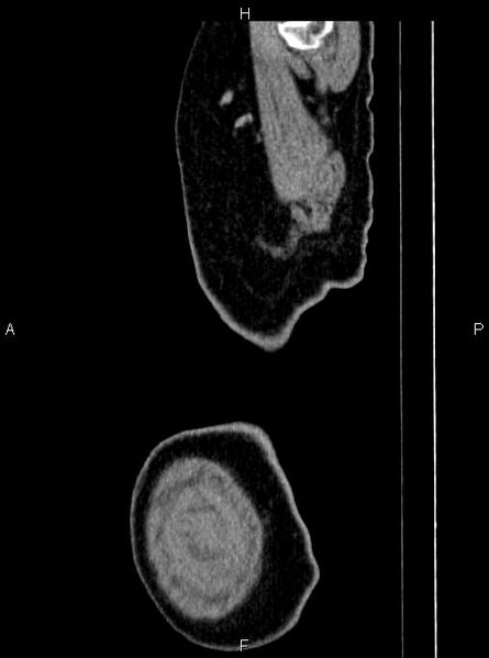 File:Abdominal aortic aneurysm (Radiopaedia 83094-97462 Sagittal renal cortical phase 3).jpg