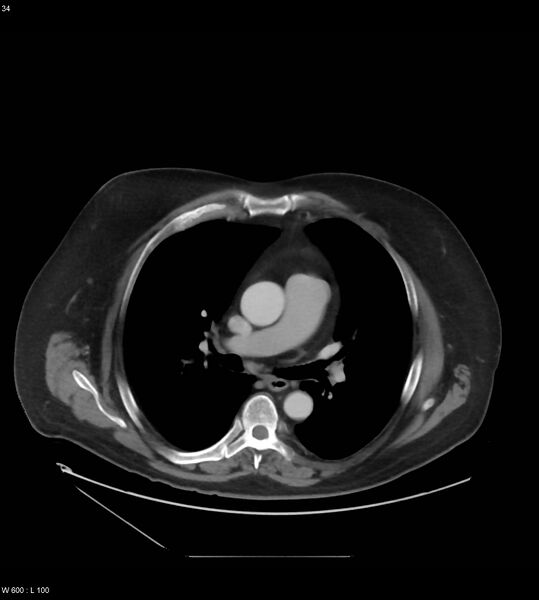 File:Abdominal aortic aneurysm with intramural hematoma then rupture (Radiopaedia 50278-55631 Axial C+ arterial phase 25).jpg