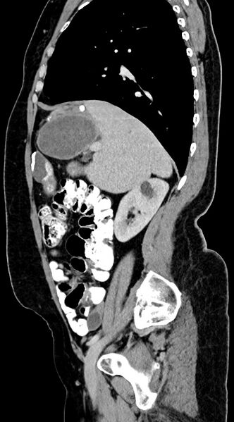 File:Abdominal hydatid disease (Radiopaedia 68223-77737 Sagittal C+ portal venous phase 49).jpg