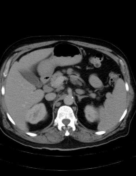File:Abdominal lymphoma - with sandwich sign (Radiopaedia 53486-59492 Axial C+ portal venous phase 15).jpg