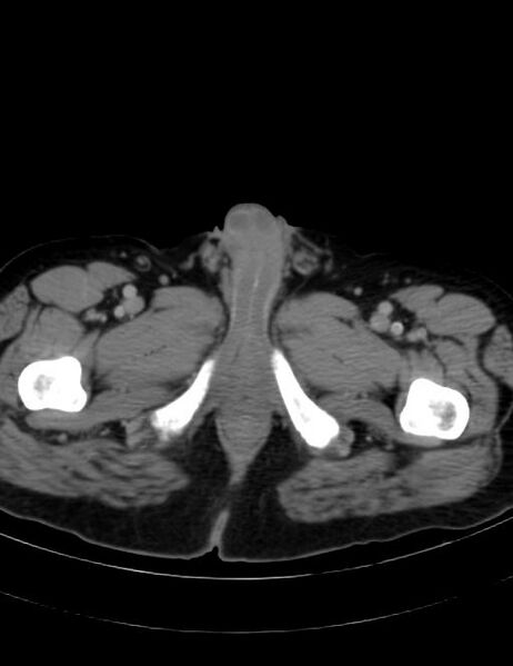 File:Abdominal lymphoma - with sandwich sign (Radiopaedia 53486-59492 Axial C+ portal venous phase 55).jpg