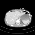 Abdominal multi-trauma - devascularised kidney and liver, spleen and pancreatic lacerations (Radiopaedia 34984-36486 Axial C+ portal venous phase 12).png