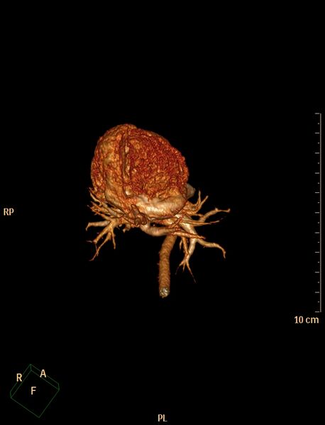 File:Aberrant left pulmonary artery (pulmonary sling) (Radiopaedia 42323-45435 3D reconstruction C+ CTPA 7).jpg