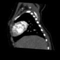Aberrant left pulmonary artery (pulmonary sling) (Radiopaedia 42323-45435 Sagittal C+ arterial phase 11).jpg