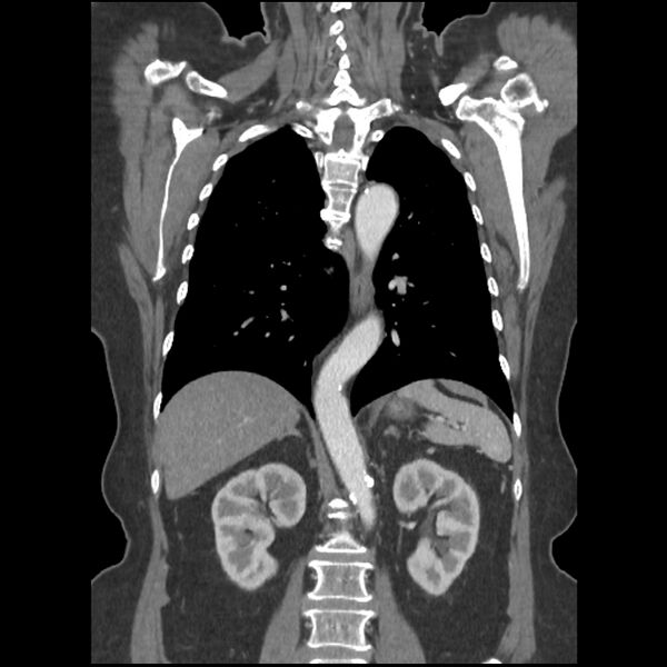 File:Aberrant right subclavian and left vertebral arteries (Radiopaedia 43467-46847 Coronal C+ portal venous phase 58).jpg