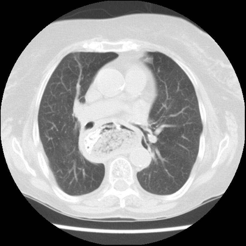 Achalasia (Radiopaedia 44094-47649 Axial lung window 28).jpg