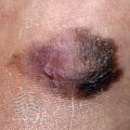 Acral lentignous melanoma (DermNet NZ lesions-melanoma-s-alm9).jpg