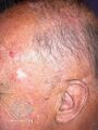 Actinic Keratoses treated with imiquimod (DermNet NZ lesions-ak-imiquimod-3766).jpg