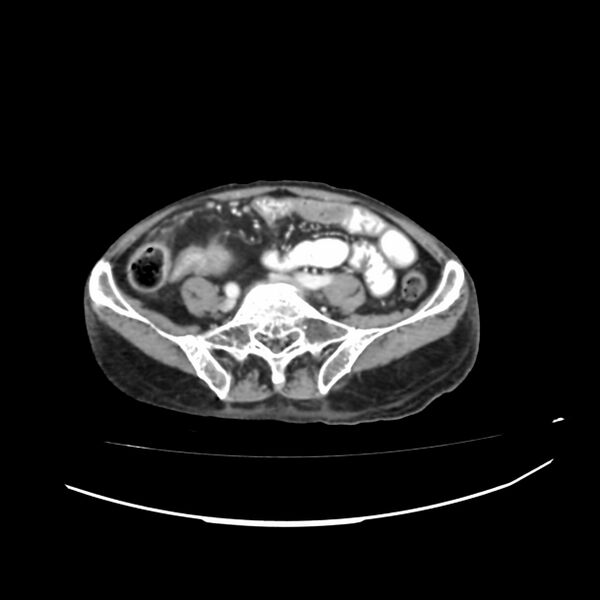 File:Acute-on-chronic Crohn disease with enteroenteric fistula (Radiopaedia 66686-75987 B 36).jpg