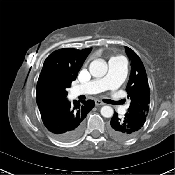 File:Acute-on-chronic pulmonary emboli (Radiopaedia 27925-28169 C+ CTPA 38).jpg