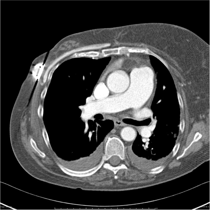 Acute-on-chronic pulmonary emboli (Radiopaedia 27925-28169 C+ CTPA 38).jpg