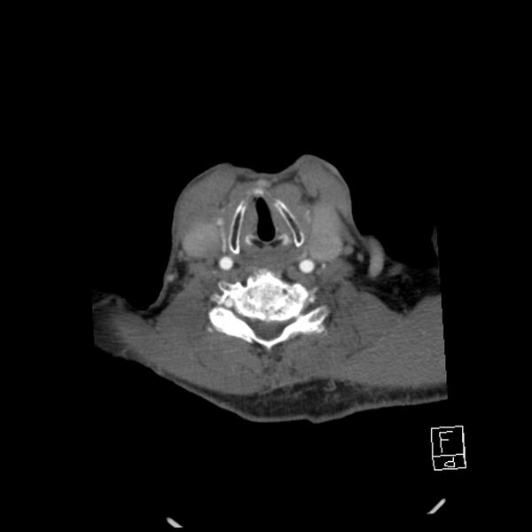 File:Acute ICA ischemic penumbra due to high-grade CCA stenosis (CT perfusion) (Radiopaedia 72038-82530 Axial C+ arterial phase 57).jpg