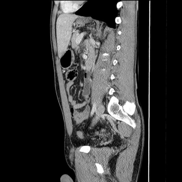 File:Acute appendicitis (Radiopaedia 27049-27227 Sagittal C+ portal venous phase 49).jpg
