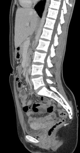 File:Acute appendicitis (Radiopaedia 62608-70901 Sagittal C+ portal venous phase 17).jpg