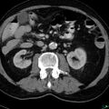 Acute appendicitis arising from a malrotated cecum (Radiopaedia 19970-19997 Axial C+ portal venous phase 11).jpg