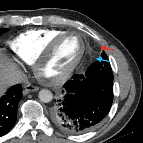 File:Acute epicardial fat necrosis (Radiopaedia 42327-45443 Axial zoom 1).jpg