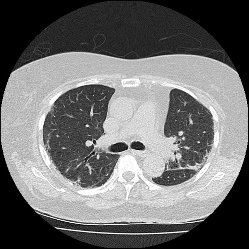 Acute interstitial pneumonitis (Radiopaedia 45404-49452 Axial lung window 39).jpg
