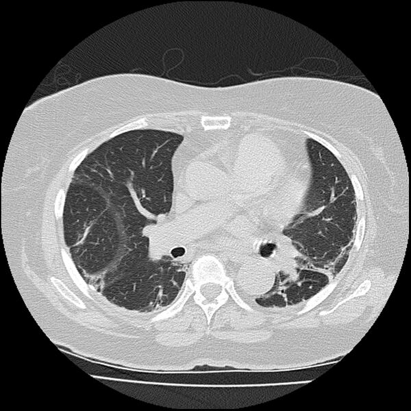 File:Acute interstitial pneumonitis (Radiopaedia 45404-49452 Axial lung window 48).jpg