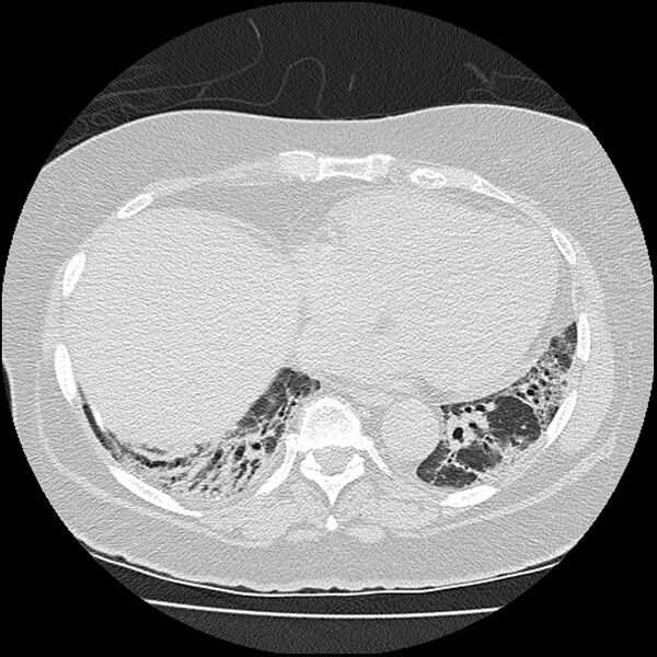 File:Acute interstitial pneumonitis (Radiopaedia 45404-49452 Axial lung window 66).jpg
