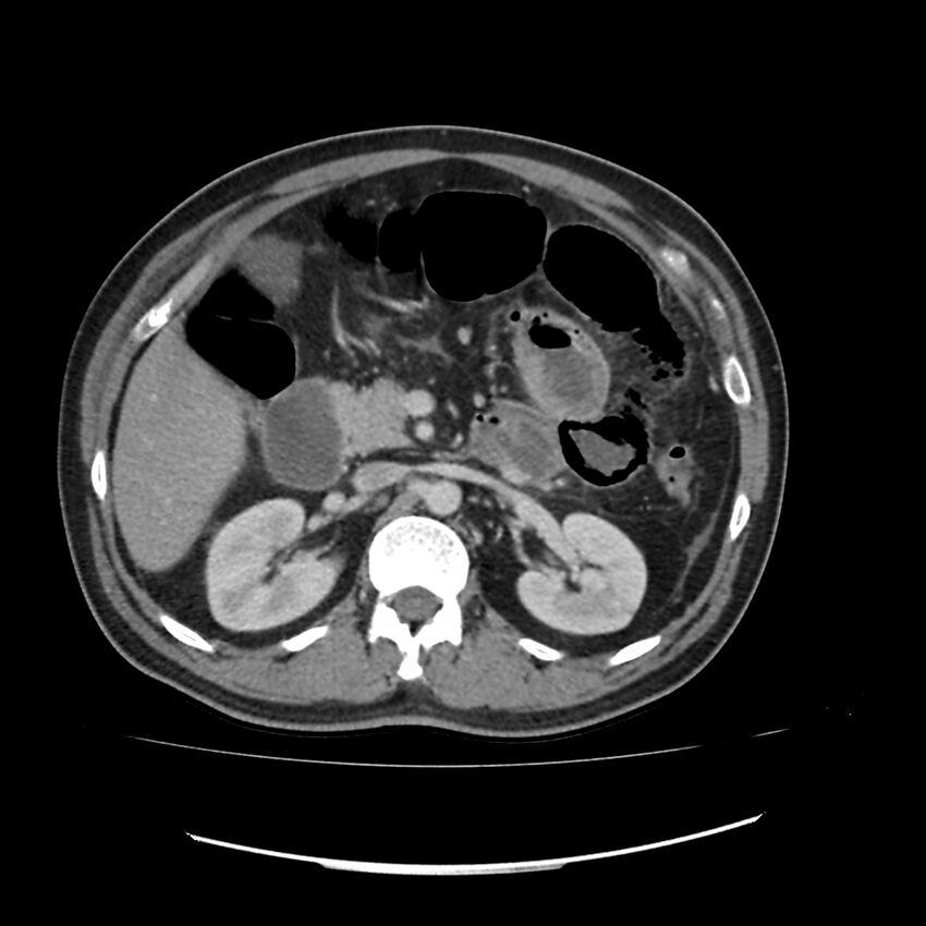 Acute mesenteric ischemia - superior mesenteric artery thrombosis (Radiopaedia 73947-84776 Axial C+ portal venous phase 38).jpg
