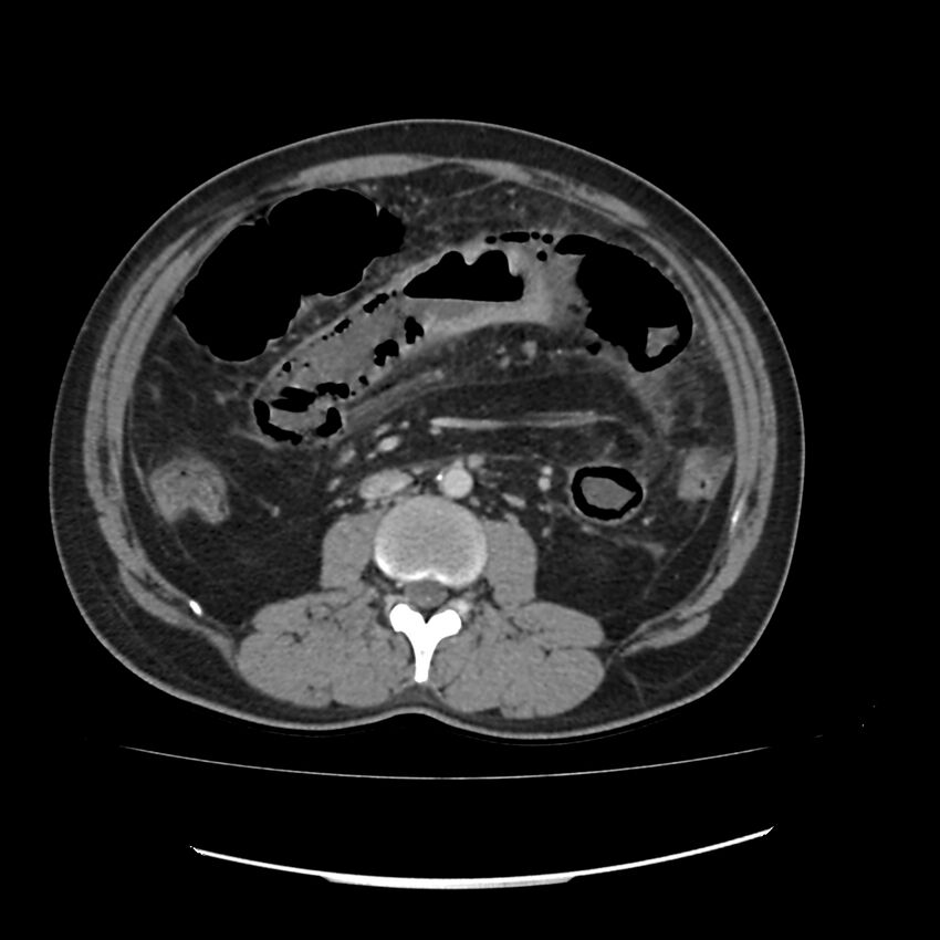 Acute mesenteric ischemia - superior mesenteric artery thrombosis (Radiopaedia 73947-84776 Axial C+ portal venous phase 68).jpg