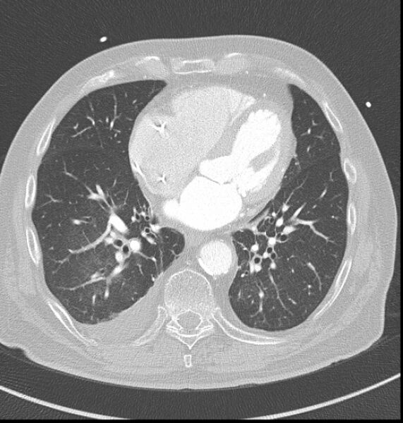 File:Acute myocardial infarction (Radiopaedia 23413-23481 lung window 44).jpg