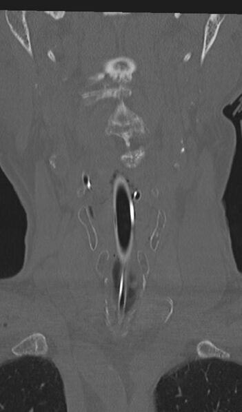 File:Acute on chronic subdural hematoma and thoracic vertebral injury in a multitrauma patient (Radiopaedia 31698-32619 Coronal bone window 8).jpg