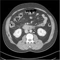 Acute pancreatitis - mild (Radiopaedia 27796-28033 C+ portal venous phase 25).jpg
