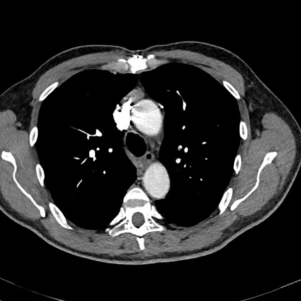 File:Acute pulmonary embolism (Radiopaedia 81677-95570 Axial C+ CTPA 14).jpg